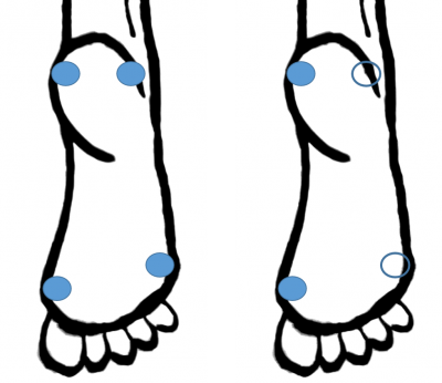 Schienbeinkantensyndrom / Shin Splints: Fußbelastung Übung